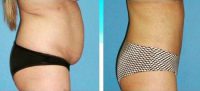 Dr. Michael L. Workman, MD, Vancouver Board Certified Plastic Surgeon Types Of Tummy Tuck Procedures Patient