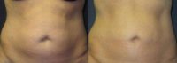 45-54 year old woman treated with Liposuction