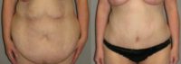 35-44 year old woman treated with Tummy Tuck
