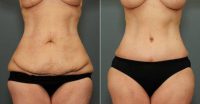 Dr. Owen Reid, MD, Richmond Plastic Surgeon - 46 Year Old Woman Requesting Tummy Tuck After Weight Loss