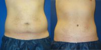 25-34 year old man treated with Tummy Tuck with Liposuction of Hips.