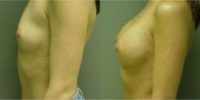 18-24 year old woman treated with Breast Augmentation