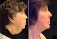 53 year old female before and after neck and face lift