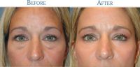 25-34 year old woman treated with Lower Blepharoplasty