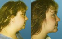 Lipoplasty - Neck Before & After