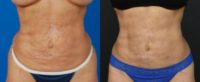 45-54 year old woman treated with Liposuction Revision