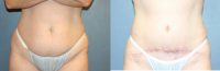 Tummy Tuck with Muscle Repair and Laser Liposuction