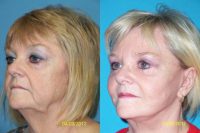 Facelift with fat grafting