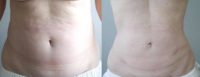 Liposuction - Hunter Moyer, MD