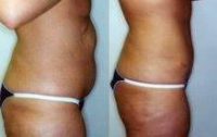 Female Patient Who Underwent Surgery For Major Weight Loss Before With Dr. John Noonan, MD , Albany Plastic Surgeon