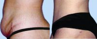 Female Tummy Tuck Before With Doctor Mary Ann Contogiannis, MD, Greensboro Plastic Surgeon