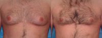Gynecomastia/Male Breast Reduction