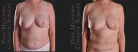 immediate unilateral (left) DIEP Flap; fat grafting; right breast reduction; nipple reconstruction; areola pigmentati