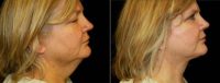 woman treated with Facelift