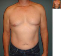 Laser Liposuction of chest and abdomen of 53 year old man