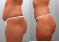 Liposuction of the abdomen, flanks and waist line