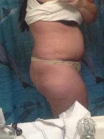 Liposuction Tummy Tuck Pic With Dr. Amy M. Sprole, MD, Wichita Board Certified Plastic Surgeon