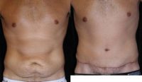 Male tummy Tuck, Flank Liposuction