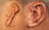 Microtia or Ear Reconstruction Surgery