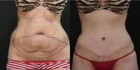 Woman Treated with a Full Tummy Tuck