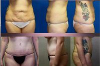 Partial Tummy Tuck Results By Dr. Clifford King, MD, Middleton Board Certified Plastic Surgeon