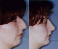 Rhinoplasty/Nose Surgery with Chin Implant