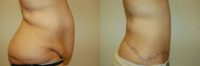 Tummy Tuck Before and After Pictures in Staten Island, NY