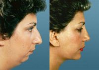 Rhinoplasty - Before & After
