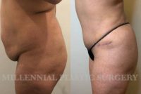 Woman treated with Tummy Tuck