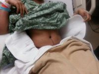 Tummy Tuck After C Section By Doctor Ed Breazeale, Jr., MD, Knoxville Board Certified Plastic Surgeon
