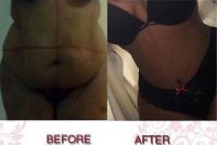 Tummy Tuck Surgery Photo With Dr Aaron J. Mayberry, MD, FACS, Albuquerque Board Certified Plastic Surgeon