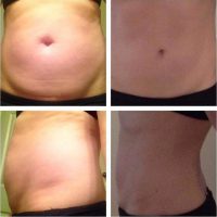 Types Tummy Tuck Results With Dr Arian Mowlavi, MD, FACS, Laguna Beach Board Certified Plastic Surgeon