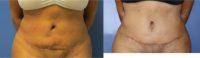 18-24 year old woman treated with Tummy Tuck Revision