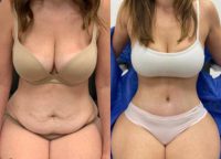 25-34 year old woman treated with Mommy Makeover
