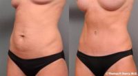 29 year old woman treated with Tummy Tuck