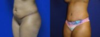 31 year old woman treated with Tummy Tuck