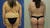 25-34 year old woman treated with Brazilian Butt Lift