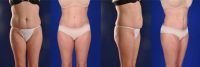 40 year-old woman who underwent a Tummy Tuck, SAFE lipo and BBL