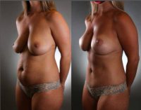 35-44 year old woman treated with Breast Augmentation and Tummy Tuck