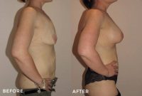 35-44 year old woman treated with Mommy Makeover