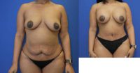 35-44 year old woman treated with Mommy Makeover