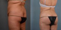 45-54 year old woman treated with Liposuction