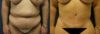 49 year old woman treated with Tummy Tuck