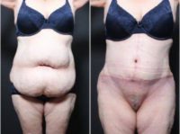 45-54 year old woman treated with Weight Loss