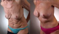 55-64 year old woman treated with Breast Lift with Implant Exchange and Mini Tummy Tuck
