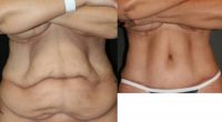 55-64 year old woman treated with Tumescent Liposuction