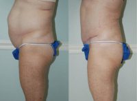65-74 year old woman treated with Tummy Tuck