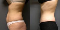 Abdominoplasty - 31 year old female, 2 months post-op