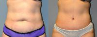 Abdominoplasty - 42 year old female, 2 months post-op