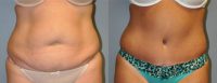 Abdominoplasty - 44 year old female, 2 months post-op